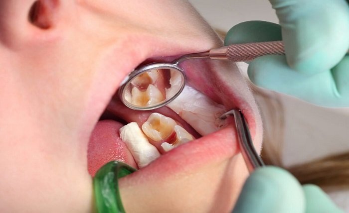 Cavity